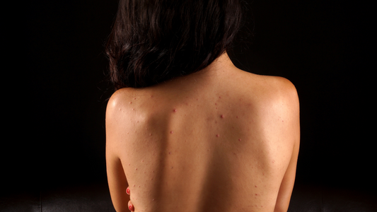 Battling Bacne? Here’s Everything You Need to Know